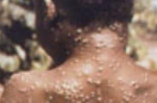 Monkeypox
